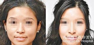 垫鼻子图片,垫鼻子术后的惊艳蜕变