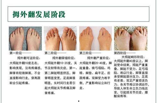 脚大拇指外翻图片